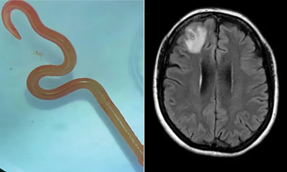 El espécimen de larva que los cirujanos del hospital de Canberra extrajeron viva del cerebro de la mujer.