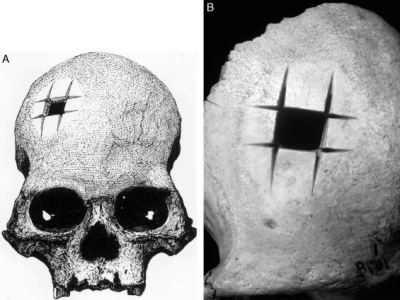El cráneo con un agujero perfecto que confirmó que los incas realizaban complejas cirugías con éxito